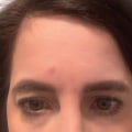 How Many Botox Injections Do You Need for the Forehead?