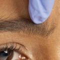 What Do Botox Injections Do? A Comprehensive Guide